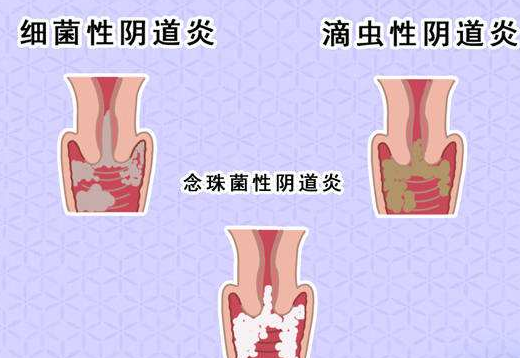 阴道分泌物蜜桃视频在线观看免费剖析什么是细菌性阴道炎