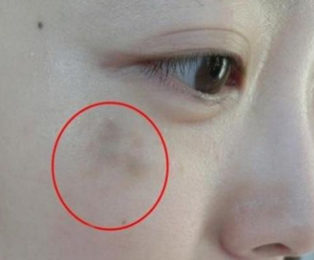 妇科阴道分泌物蜜桃视频在线观看免费提醒女人妇科炎症在脸上的表现
