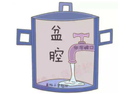 盆腔积液是怎么回事？白带蜜桃视频黄网站厂家提醒早了解早预防