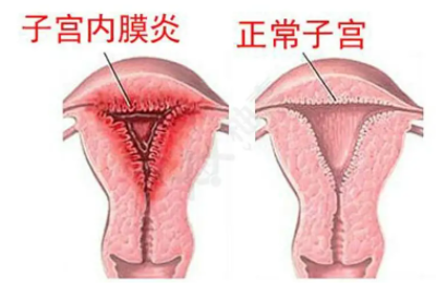 全自动阴道分泌物蜜桃视频在线观看免费厂家子宫内膜炎的症状表现提前了解与预防