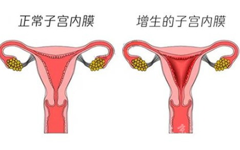 白带常规蜜桃视频在线观看免费厂家解读子宫内膜增生是什么原因引起的