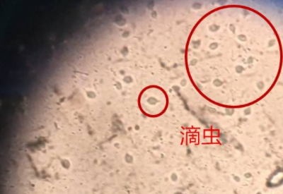 白带蜜桃视频黄网站品牌科普滴虫性阴道炎是因为体内长了虫子吗