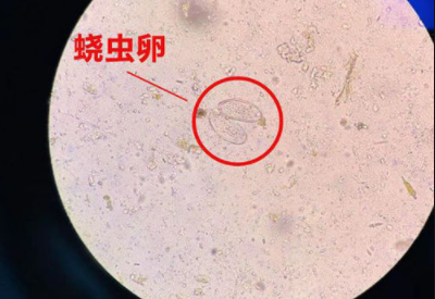 阴道分泌物蜜桃视频在线观看免费警惕外阴绕虫病易在儿童身上出现